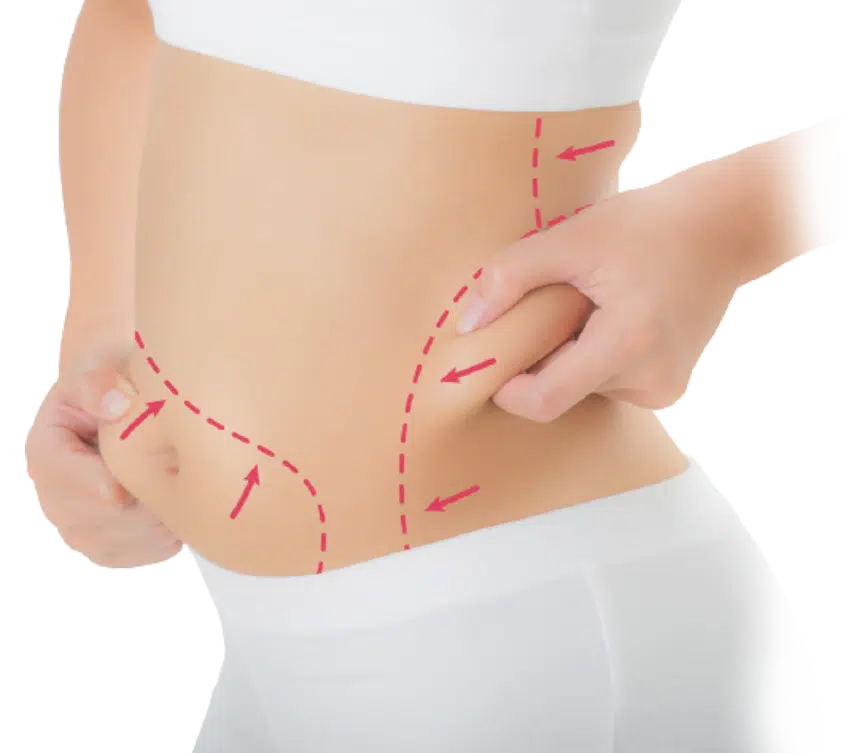 Liposuction surgery
