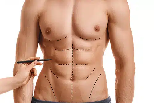 Six Pack Surgery